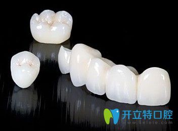 單顆與連冠烤瓷牙圖示