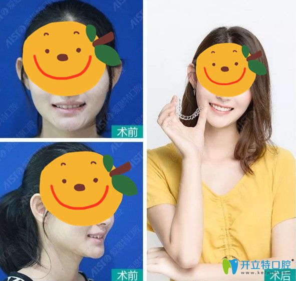 在愛思特矯正牙齒之后側(cè)臉有了小改變