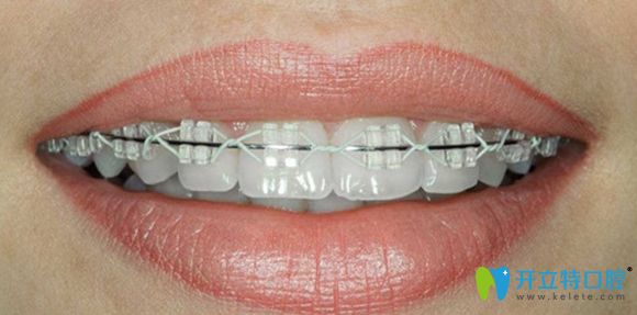 陶瓷半隱形托槽矯正效果圖 陶瓷半隱形托槽矯正效果圖