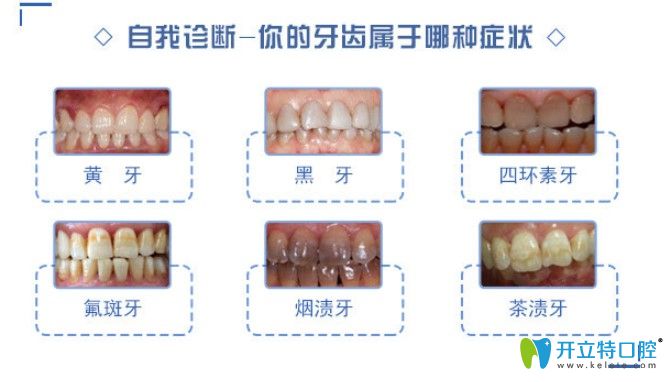 哪些牙齒情況可以做牙齒美白