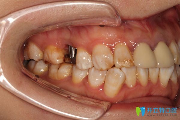 戴上種植體后圖片