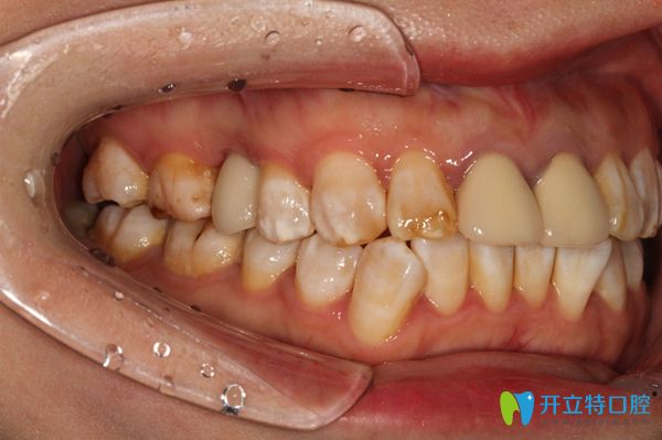 在廣州陽光樹口腔戴上牙冠后樣子