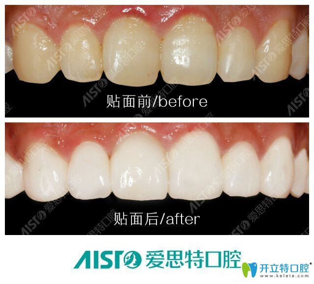 愛思特口腔牙齒貼面前后對比圖 愛思特口腔牙齒貼面前后對比圖