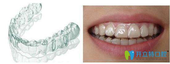 隱形牙套圖示 隱形牙套圖示