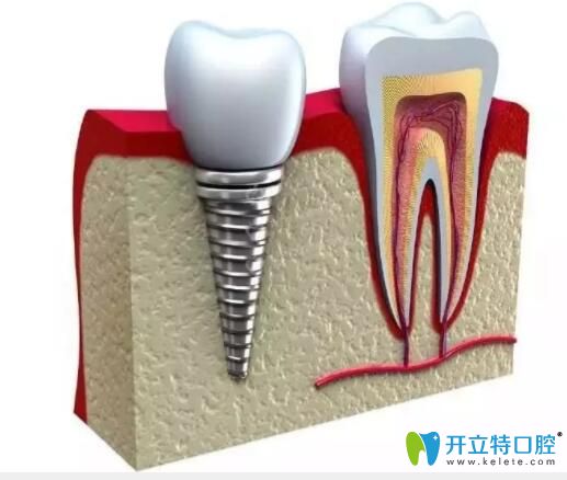 種植牙