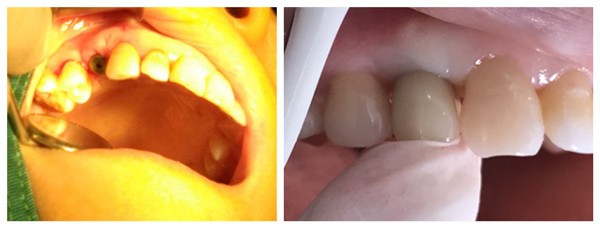 屌絲做完德國Bego種植體后的種牙使用體驗(yàn)，瞅瞅他是咋說的