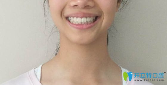 深覆合深覆蓋矯正好了的效果圖 深覆合深覆蓋矯正好了的效果圖