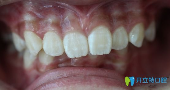 小A在廣州陽光樹口腔做正畸術(shù)前的照片 小A在廣州陽光樹口腔做正畸術(shù)前的照片