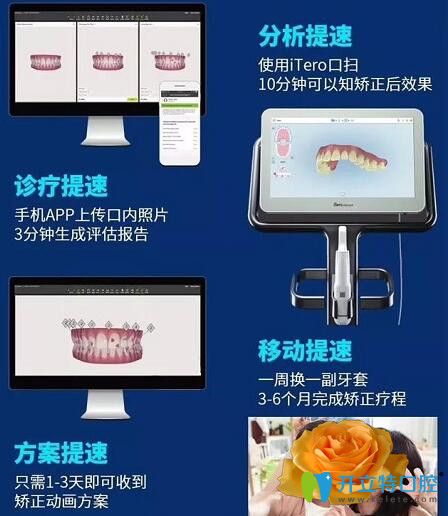 隱形牙齒矯正器隱適美極速版優(yōu)勢