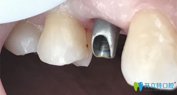 種植牙馬上就要鑲好了