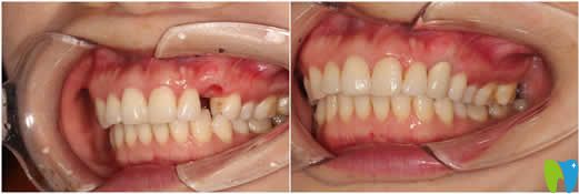 本姑娘做完種植牙后用事實(shí)告訴你美國3i種植體好不好