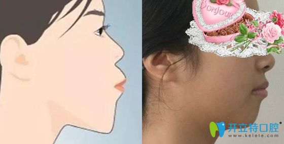 牙齒深覆合和深覆蓋對(duì)面部美觀的影響圖 牙齒深覆合和深覆蓋對(duì)面部美觀的影響圖