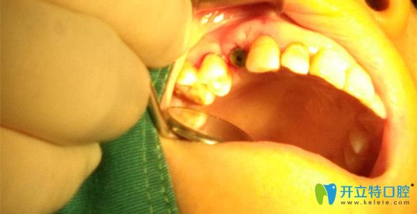 吳為我做手術中