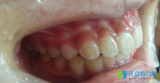 標(biāo)準(zhǔn)的牙齒咬合圖片 標(biāo)準(zhǔn)的牙齒咬合圖片