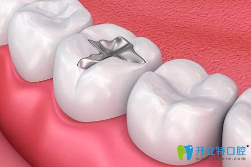 深圳格倫菲爾口腔補牙效果圖