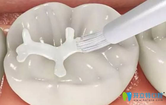 窩溝封閉示意圖 窩溝封閉示意圖