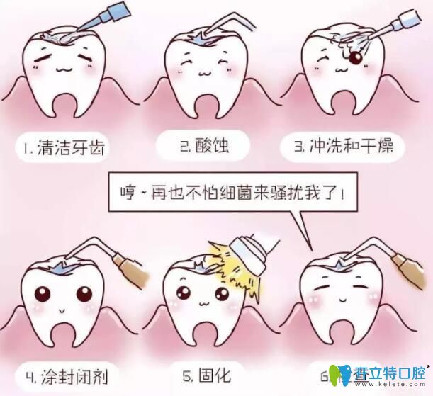 窩溝封閉 窩溝封閉