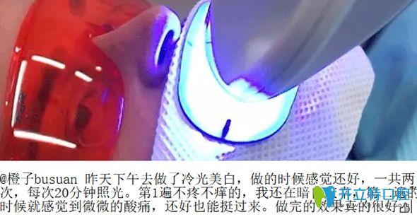 做冷光美白牙齒的過(guò)程圖