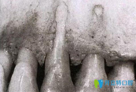 漲姿勢(shì):正畸發(fā)生骨開(kāi)窗幾率大嗎?如果牙槽骨開(kāi)窗怎么治療?