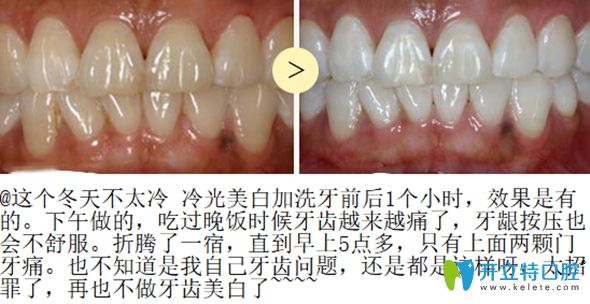 冷光美白前后效果對(duì)比圖
