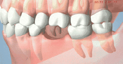 缺牙不補(bǔ)的危害 缺牙不補(bǔ)的危害