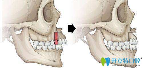 拔牙后前后對比 拔牙后前后對比