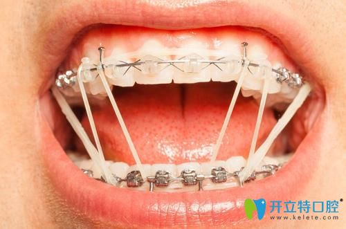 what？有人疑惑正畸橡皮筋吃飯刷牙時還得拿下來么