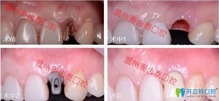 齲齒拔牙后做即刻種植牙案例分享,不當不管不顧佛系缺牙者