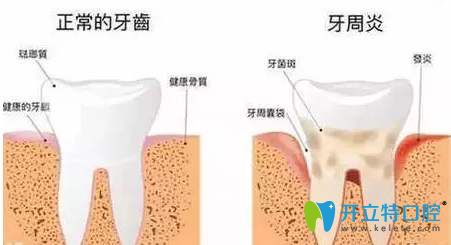 正常的牙齒和牙周炎 正常的牙齒和牙周炎