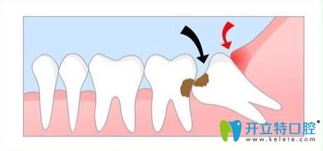 矯正時候需要拔掉齲齒 矯正時候需要拔掉齲齒
