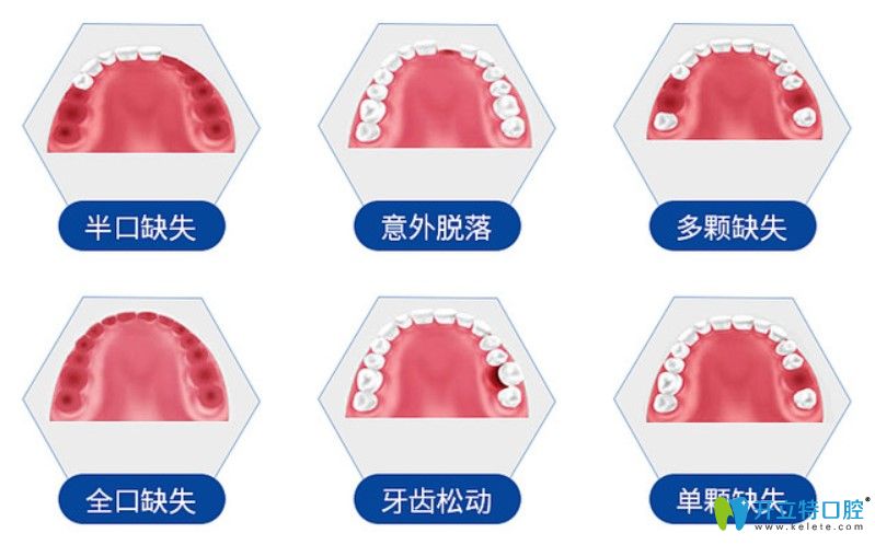 德國(guó)賽弗種植體適用于哪些牙齒