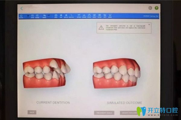 口掃儀可在術(shù)前看到矯正效果