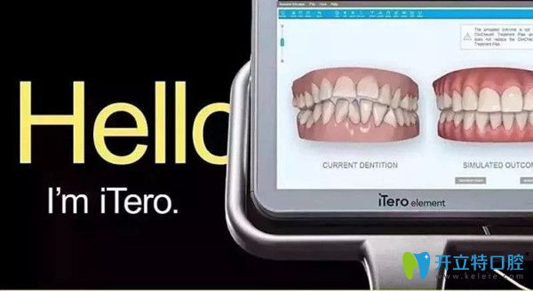 itero口掃外觀