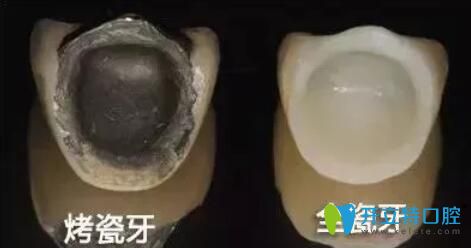 別只關(guān)心價(jià)格,德國(guó)西諾德全瓷牙好不好,看看內(nèi)行人的分析