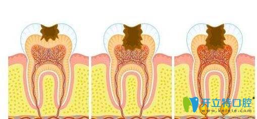 牙髓病的發(fā)展 牙髓病的發(fā)展