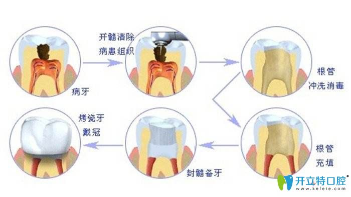 根管治療的過程 根管治療的過程