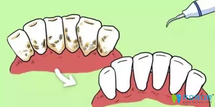 牙結(jié)石是什么