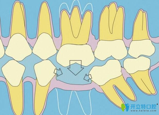 種植牙間隙不夠,正畸關(guān)閉或推開(kāi)間隙來(lái)救,注意磨牙慎選