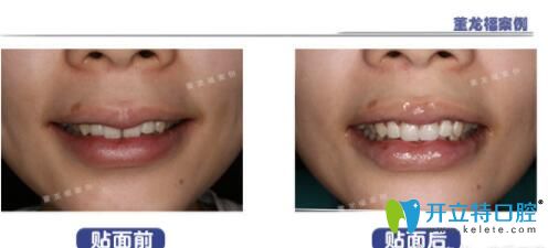 泉州維樂口腔董龍福牙齒貼面案例