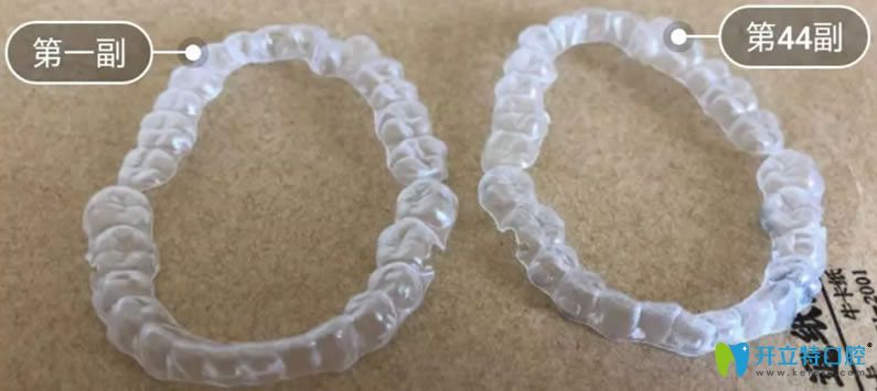 美奧口腔隱適美隱形牙套 美奧口腔隱適美隱形牙套