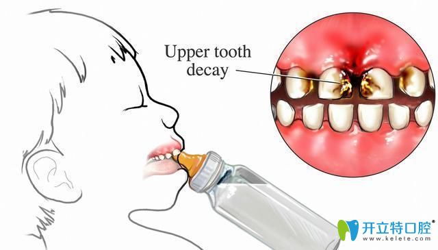 蛀蟲也有可能引起牙齒脫落