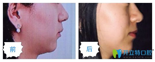 長(zhǎng)沙美奧口腔隱形矯正虎牙臉型變化 長(zhǎng)沙美奧口腔隱形矯正虎牙臉型變化