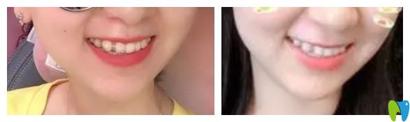隱適美隱形虎牙矯正前后 隱適美隱形虎牙矯正前后