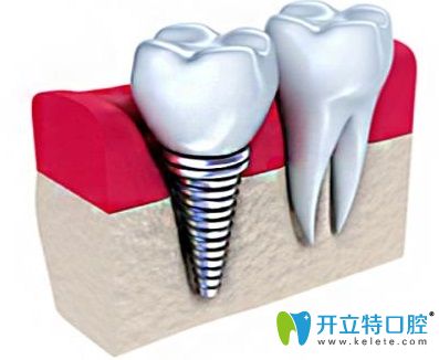 分析韓國紐百特種植體優(yōu)缺點(diǎn)就曉得它在種植系統(tǒng)中的地位