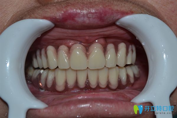 裝上種植牙后圖片 裝上種植牙后圖片