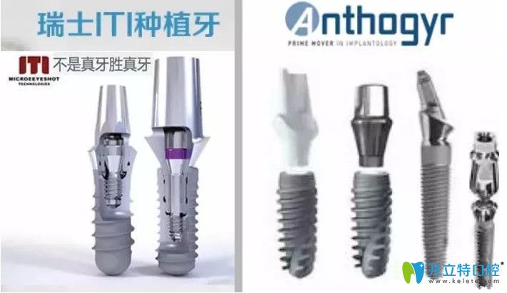 廣州廣大口腔安卓健種植體和ITI種植體