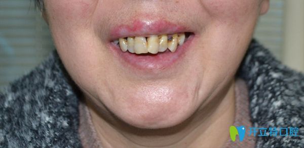 劉阿姨牙齒之前樣子 劉阿姨牙齒之前樣子
