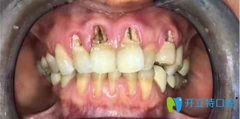 哇！這位阿姨的牙齒楔狀缺損修復(fù)效果這么贊的嗎