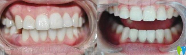 隱適美矯正齙牙效果 隱適美矯正齙牙效果