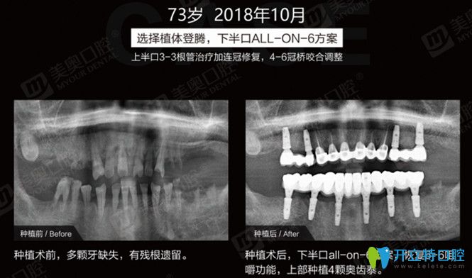 多顆牙缺失后做半口all-on-6種植